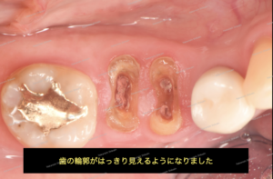 歯を抜かない・歯を残したい治療　矯正４